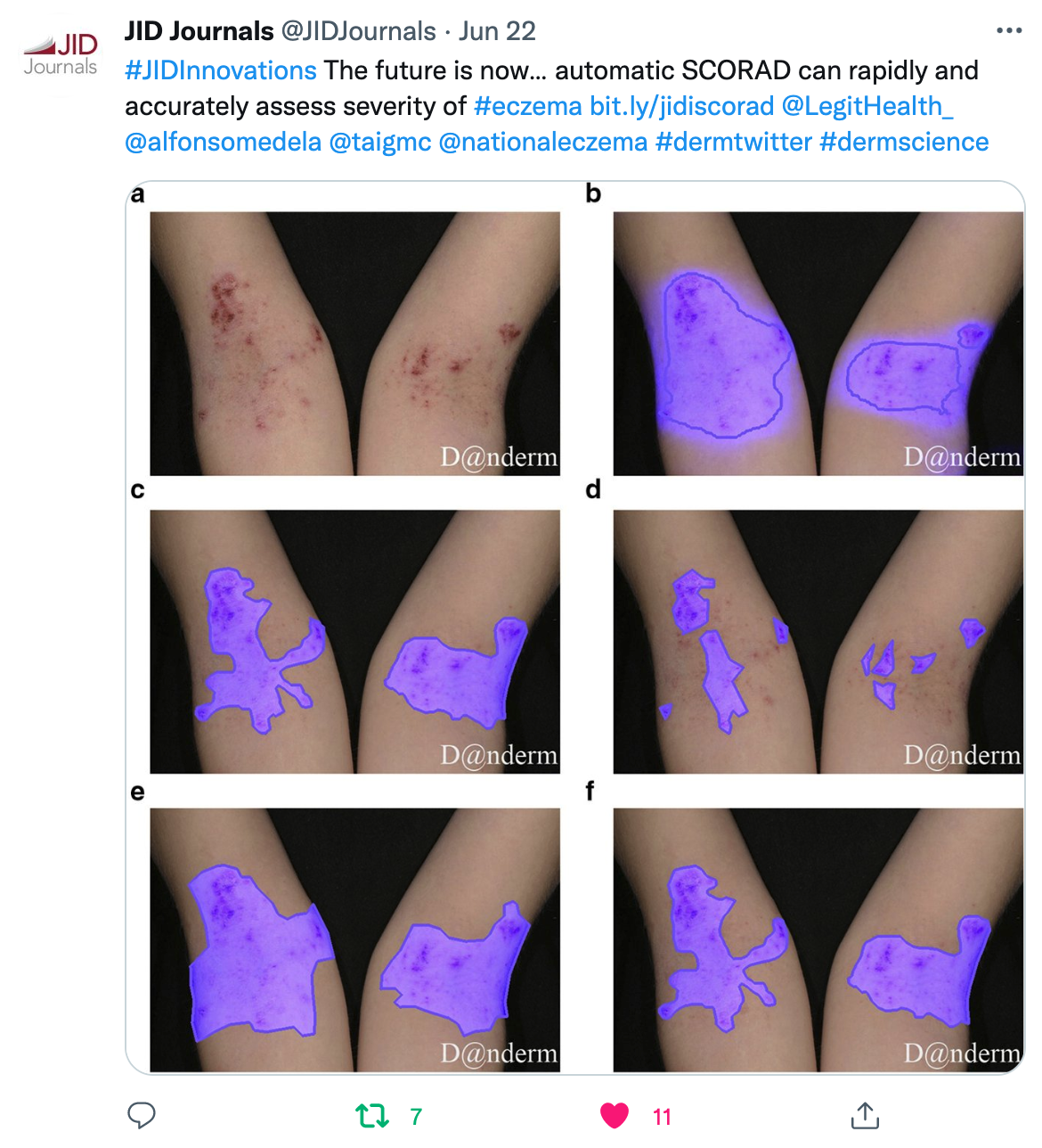 Tweet by Journal of Investigative Dermatology